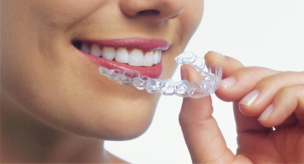 Clear Aligners – Premium Dental Center