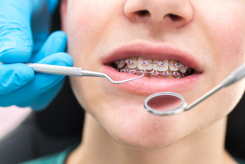 Five Things to Consider Before Seeing an Orthodontist for Braces