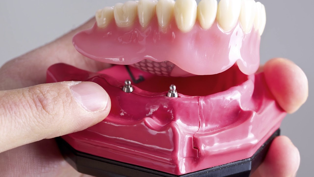 Implant Retained Dentures Premium Dental Center